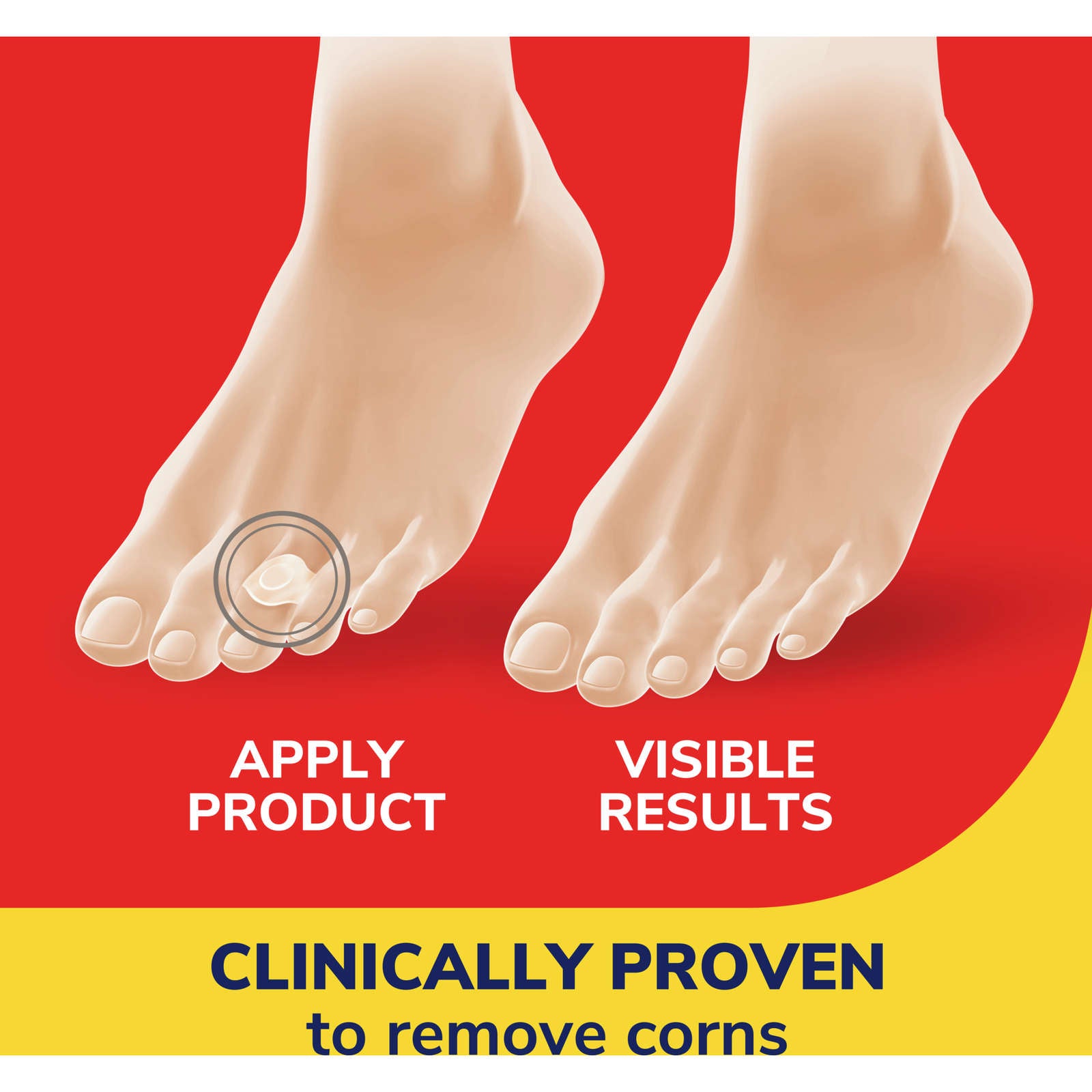 Dr. Scholl’s® One Step Corn Removers